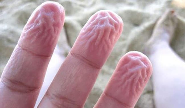 Causes of wrinkles in fingers