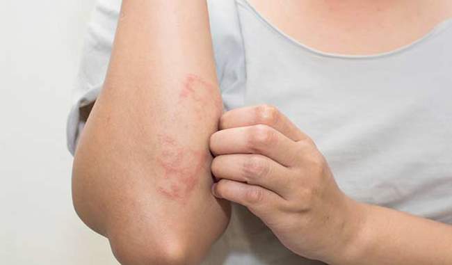 leishmaniasis-is-new-threat-for-skin