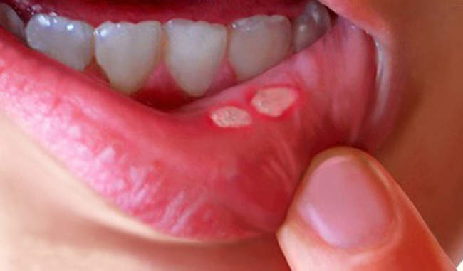 home-remedy-for-mouth-ulcer-in-hindi