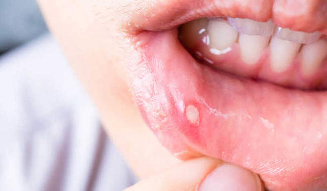 know-the-home-remedy-of-mouth-ulcer-in-hindi know-the-home-remedy-of-mouth-ulcer-in-hindi