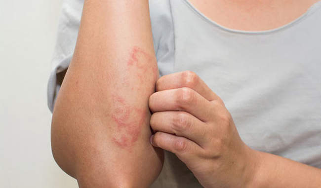 know-the-home-remedy-for-skin-rashes-in-hindi