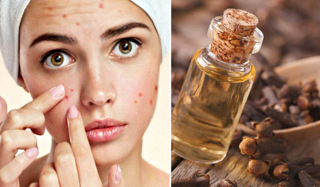 know-how-to-use-clove-oil-for-acne-in-hindi
