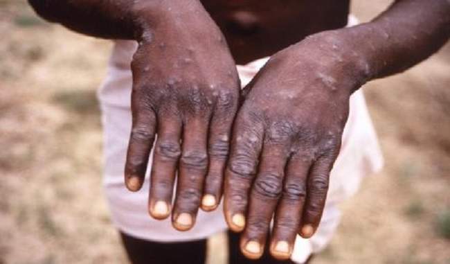 first-case-of-rare-virus-monkeypox-in-singapore-came-out