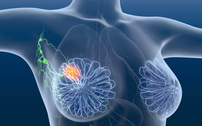 स्तन कैंसर के जोखिम का पता लगा सकता है एमआरआई