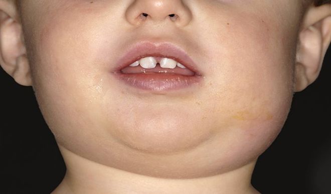 mumps mumps
