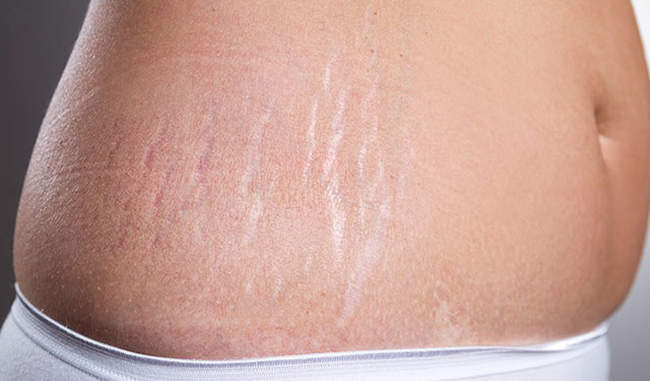 know-how-to-get-rid-of-stretch-marks-in-hindi