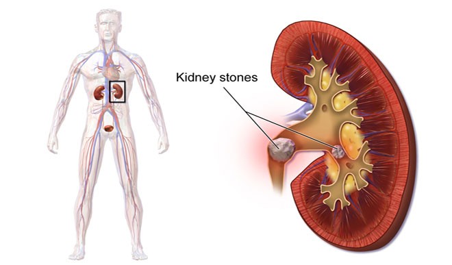 kidney stone