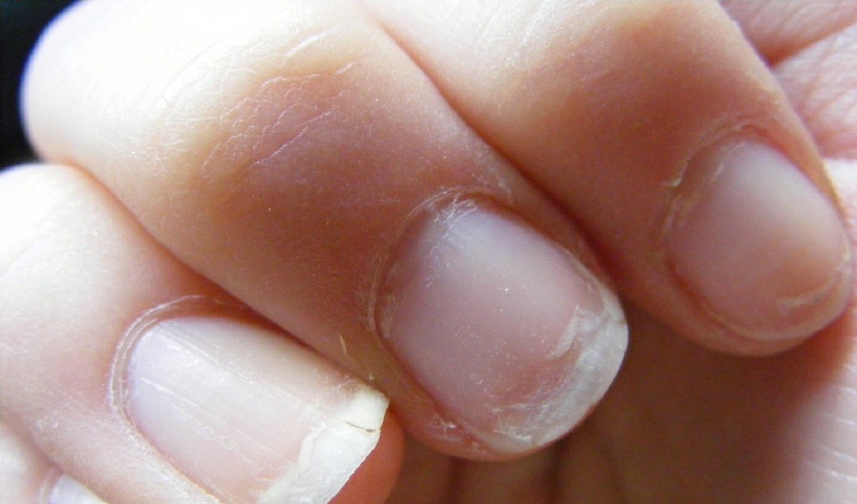 nails give indications about these serious diseases