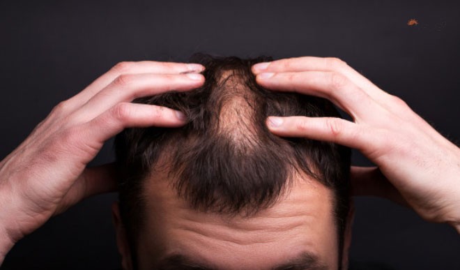 यह हैं पुरुषों के बाल झड़ने के कारण और बचाव के तरीके, जानिए... - causes and  prevention of hair loss in men