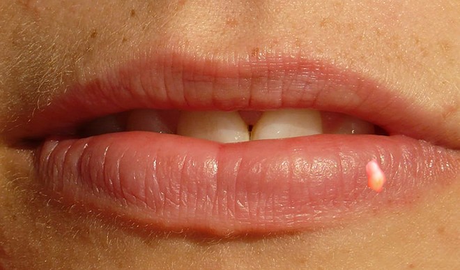 pimples lip