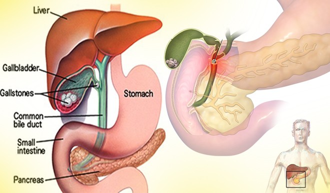 gallbladder stone