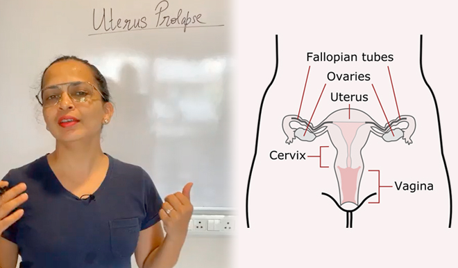 uterus prolapse reason