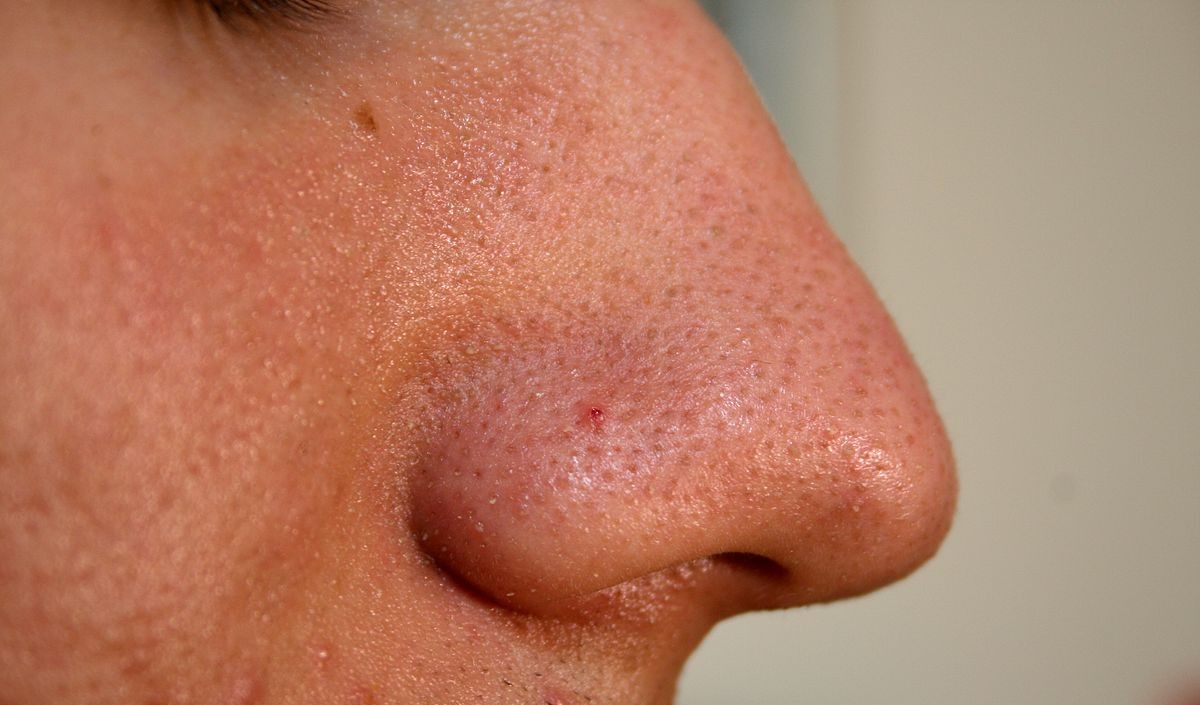  blackheads on nose