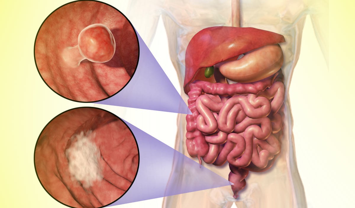 Bowel Cancer