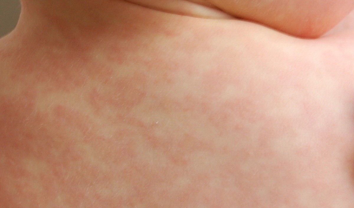 home remedies for rashes due to allergy Hindustan News Hub