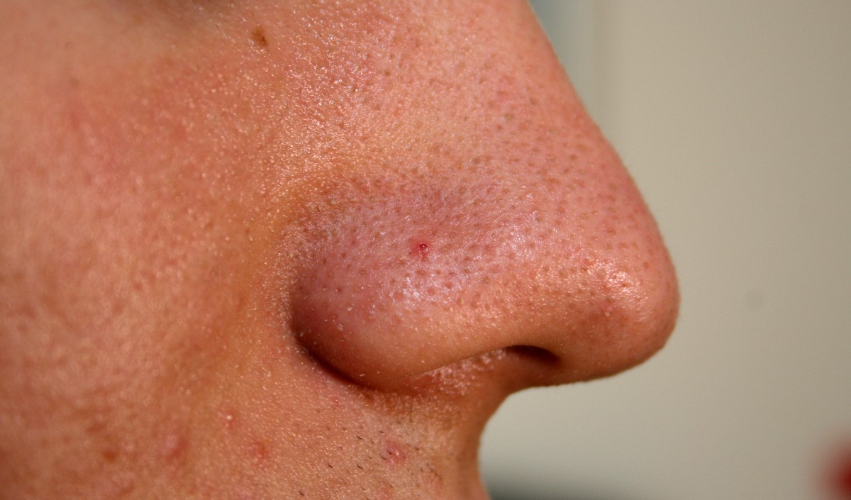  blackheads