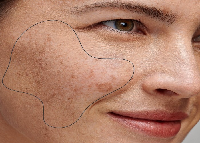 Skin Pigmentation: पिगमेंटेशन ने छीन ली है चेहरे की खूबसूरती, जानिए कैसे करें इससे बचाव