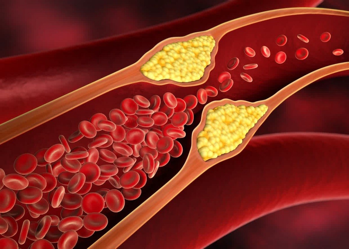 High Cholesterol Remedy: गंदा कोलेस्ट्रॉल घटाने वाली दवाएं सेहत पर पड़ सकती हैं भारी, जानें क्या है एक्सपर्ट्स की सलाह