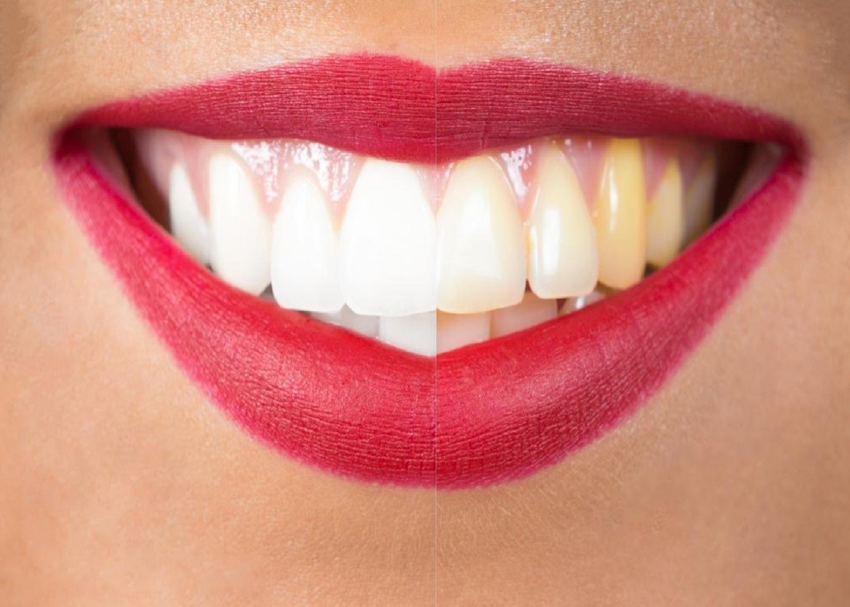Health Tips: दांतों पर जमे पीले प्लाक को ऐसे करें साफ, रिजल्ट देख हैरत में पड़ जाएंगे आप