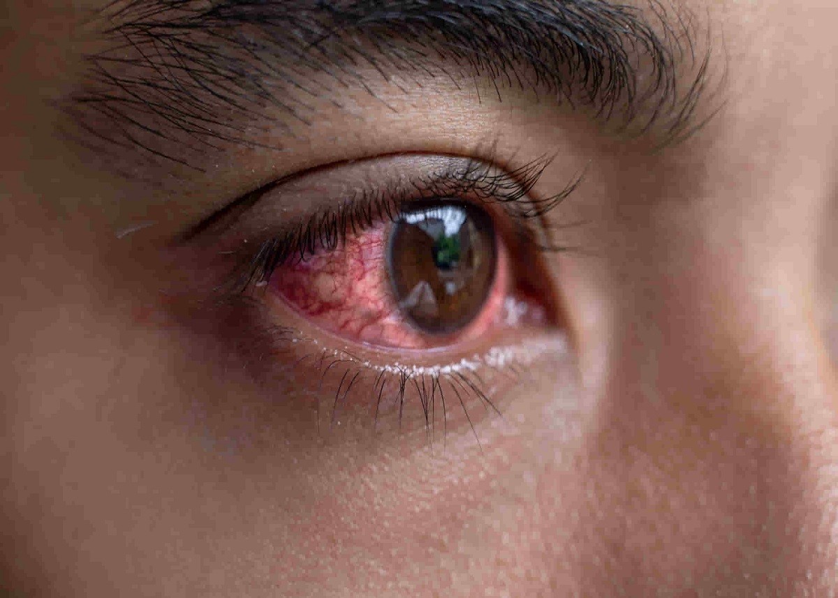 Eye Flu: बच्चों से लेकर बुजुर्गों तक में फैल रहा आई फ्लू का खतरा, जानिए क्या कहते हैं आई स्पेशलिस्ट