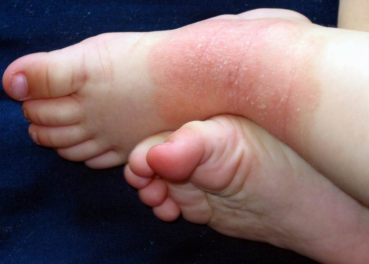 Atopic Dermatitis: नवजात शिशुओं को हो सकती है Atopic Dermatitis की समस्या, जानिए लक्षण और बचाव के तरीके
