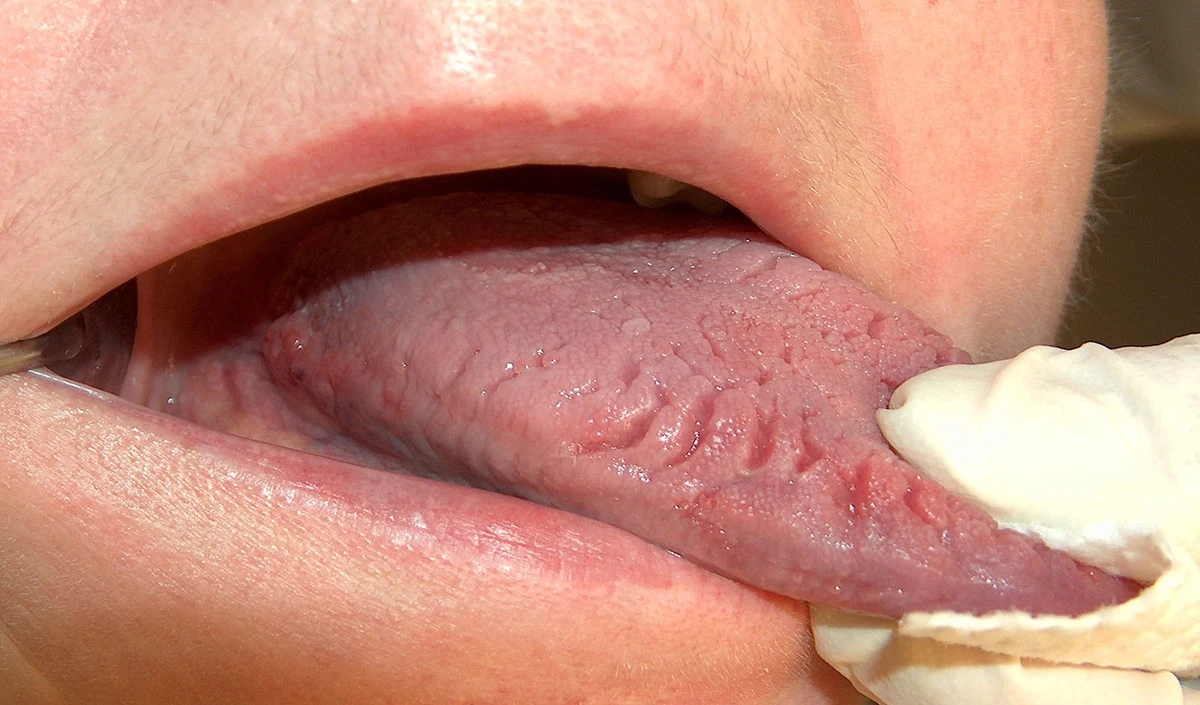 Tongue Color