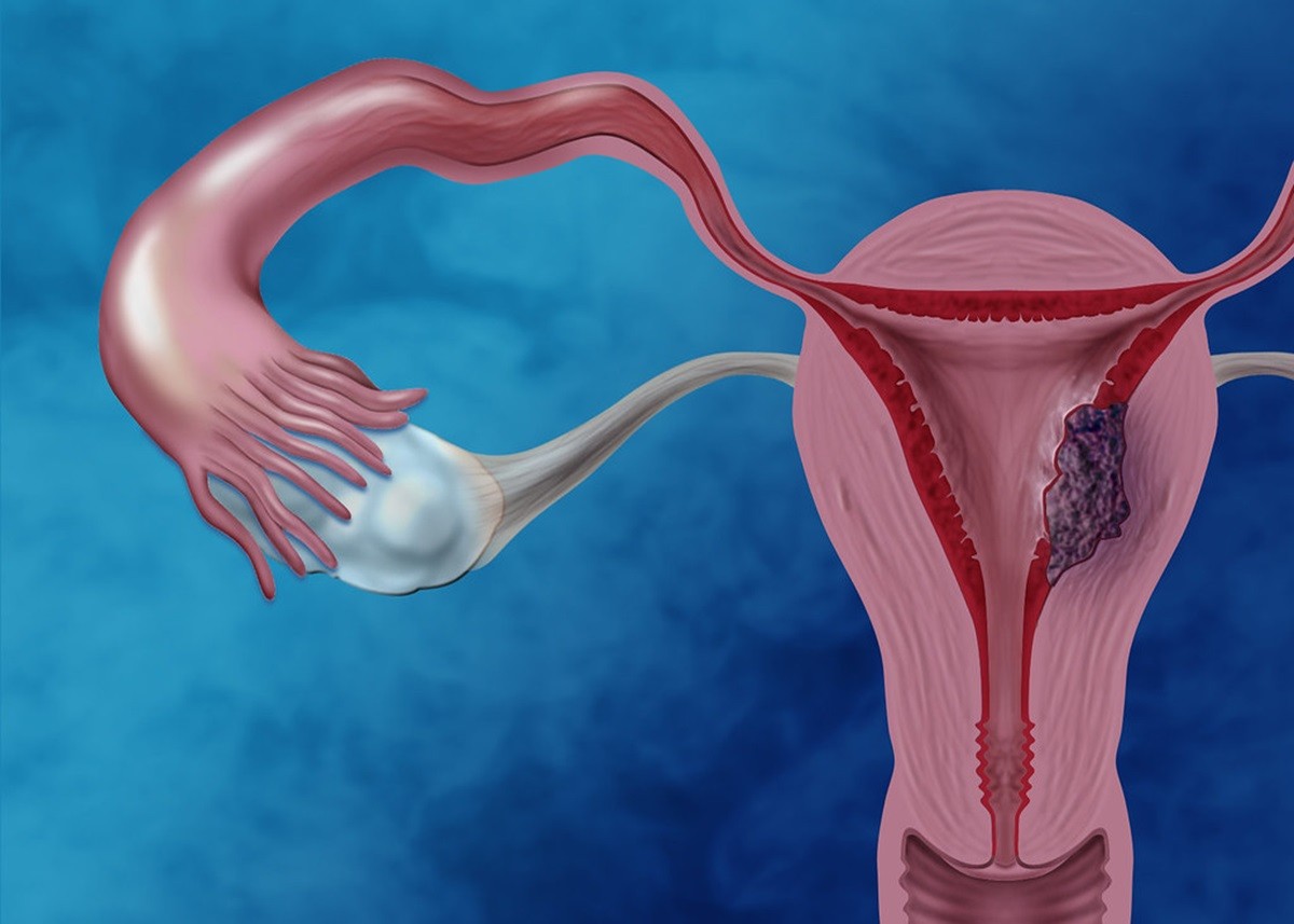 Cervical Cancer: सर्वाइकल कैंसर के इन लक्षणों को अनदेखा न करें महिलाएं, हेल्थ एक्सपर्ट्स से जानिए बचाव का तरीका 