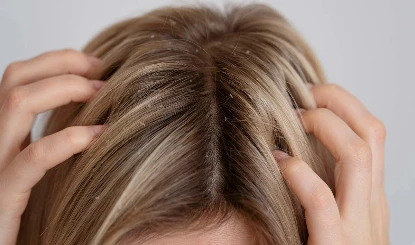 Winter Dandruff Remedies: ठंड में बढ़ते डैंड्रफ ने कर दिया है परेशान? ये नेचुरल हैक्स आएंगे आपके बेहद काम