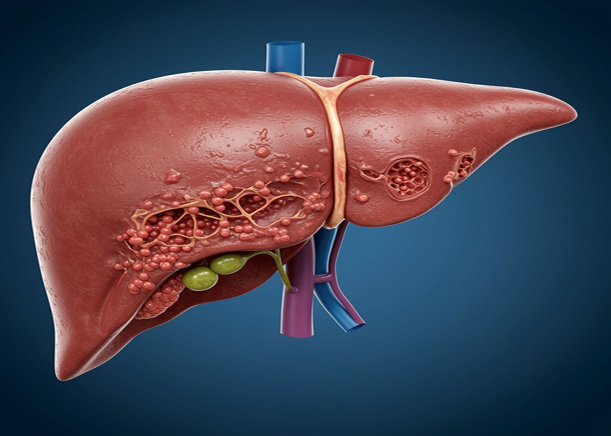 Liver Transplant: भारत बना लिवर ट्रांसप्लांट का महाशक्तिशाली केंद्र, रिपोर्ट से खुला चौंकाने वाला सच