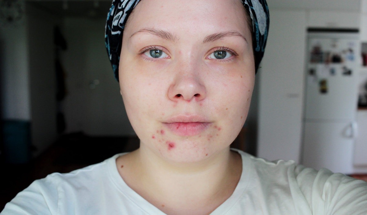 Hormonal Acne Hormonal Acne