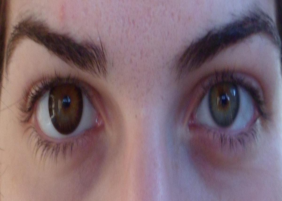 Health Tips: Dark Circles और Hair Fall को न लें हल्के में, Body में पल रही बड़ी बीमारी के हो सकते हैं ये Signs