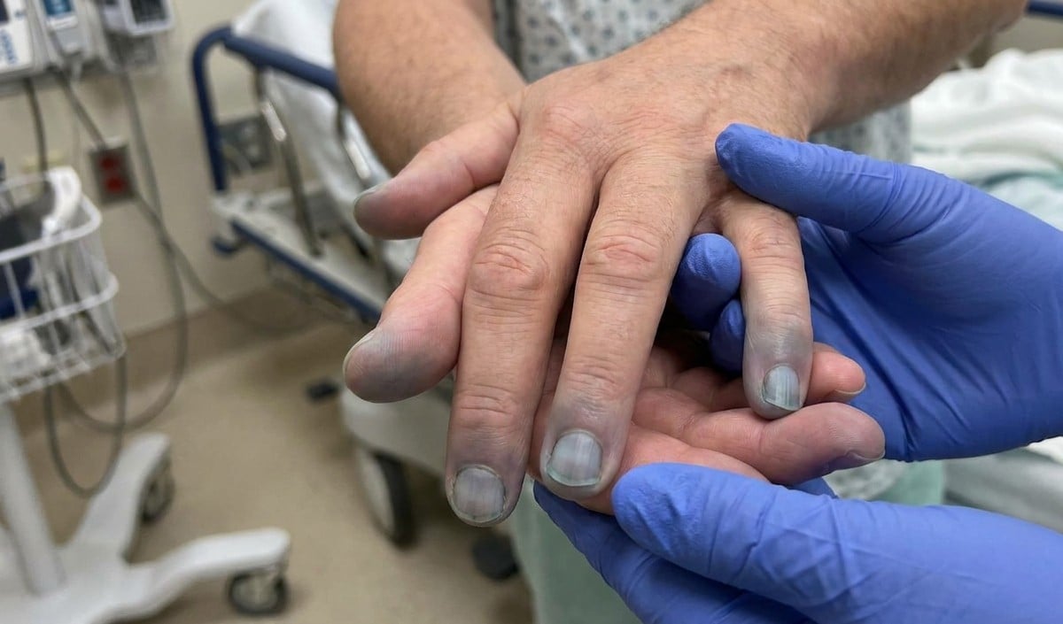 Cyanosis Cyanosis