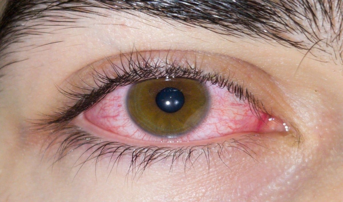 Eye Care Eye Care
