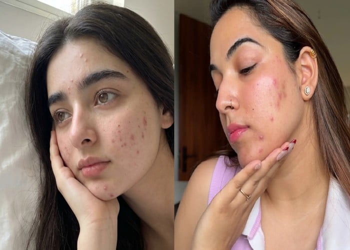Pimples Home Remedies: चेहरे पर Pimples ने किया परेशान? Green Tea और शहद का ये नुस्खा दिखाएगा जादुई असर