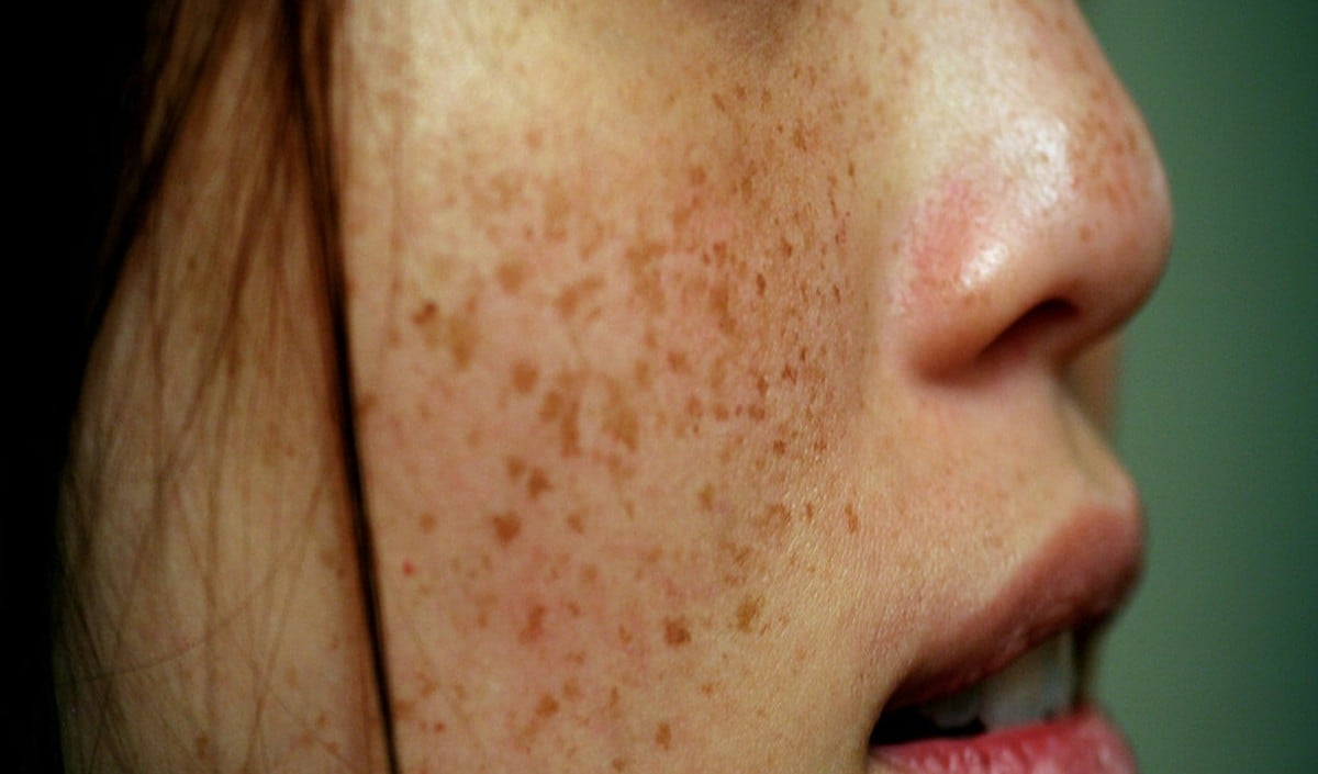 Summer Acne Summer Acne