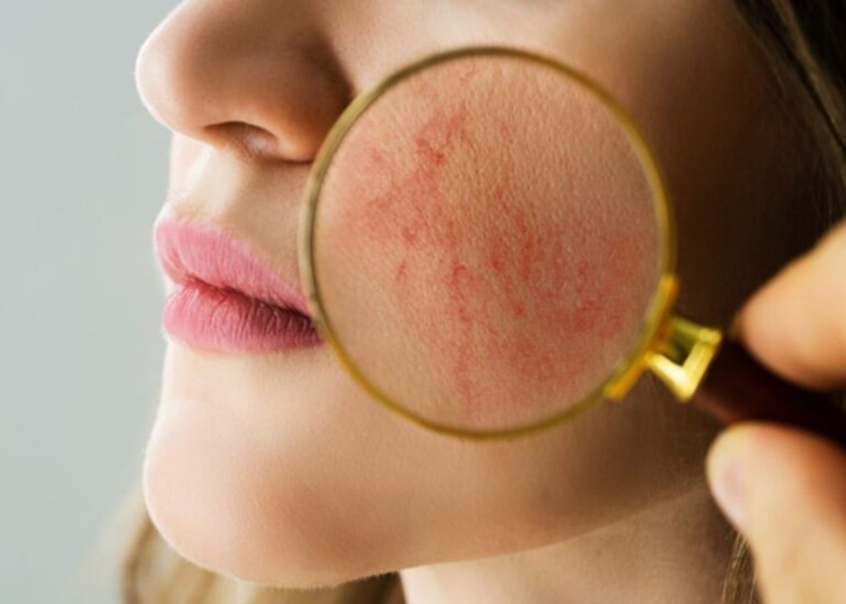 Health Tips: पेट की गर्मी नहीं, Oily-Spicy Diet है Summer Acne की असली वजह