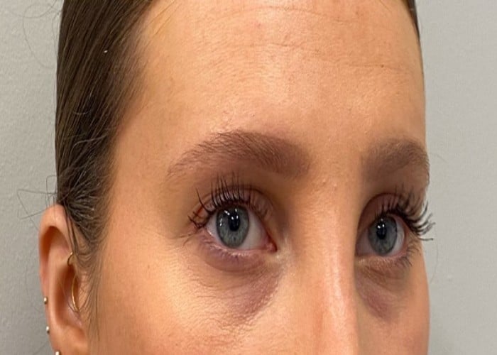 Dark Circles और आंखों की सूजन से राहत दिलाएगी यह Cucumber Home Remedy, जानें सही तरीका